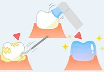 歯のメインテナンス