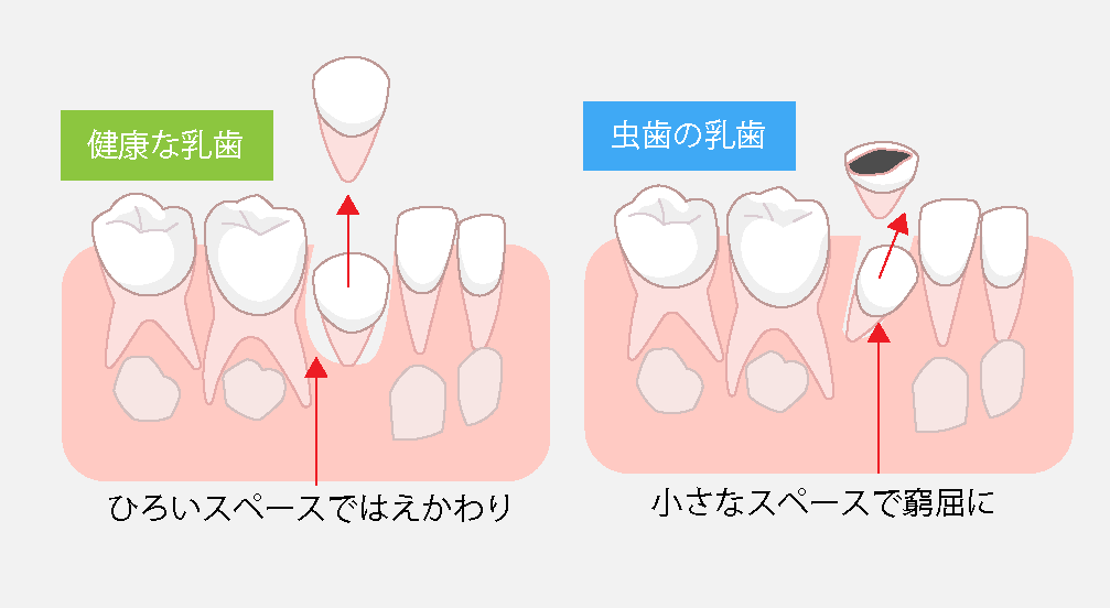 永久歯の歯並びへの影響