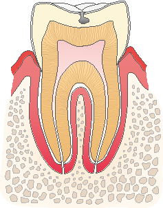 エナメル質の虫歯