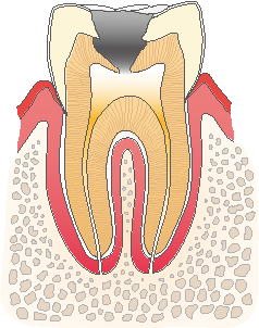 歯髄の虫歯