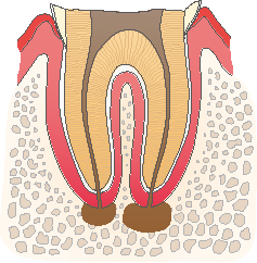 歯根の虫歯