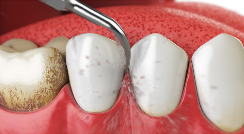 虫歯や歯周病を防ぎ歯を守る
