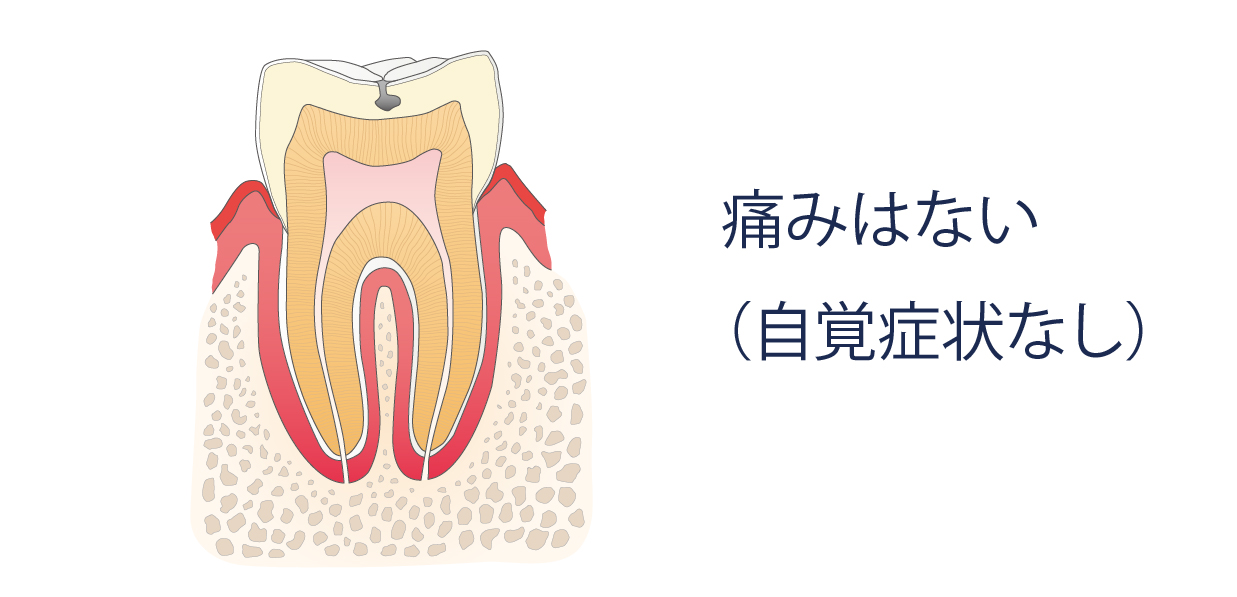 痛みはない（自覚症状なし）