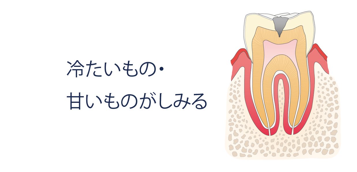 冷たいもの・甘いものがしみる