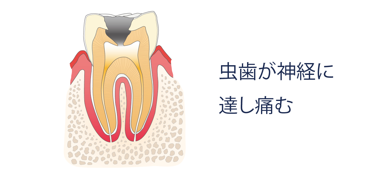 虫歯が神経に達し痛む