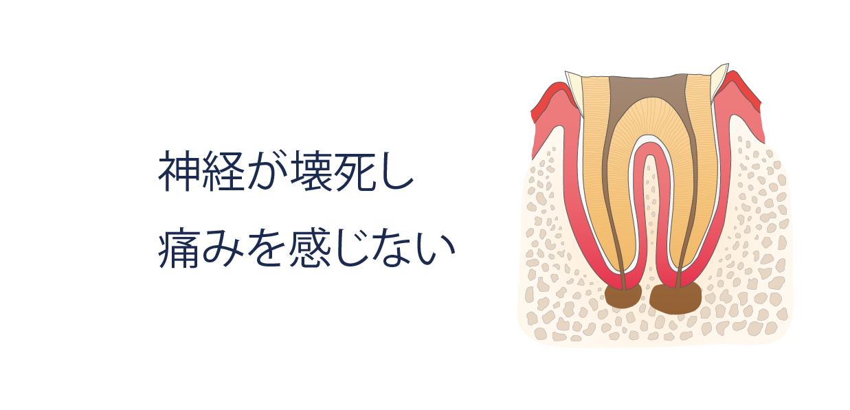 神経が壊死し痛みを感じない