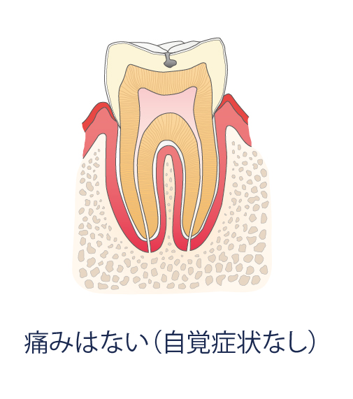 痛みはない（自覚症状なし）