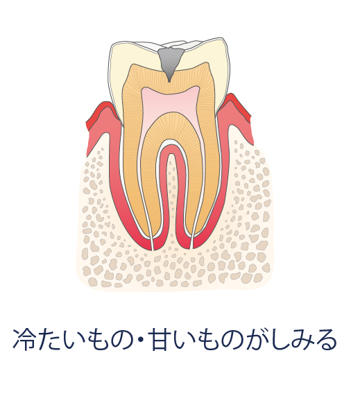 冷たいもの・甘いものがしみる