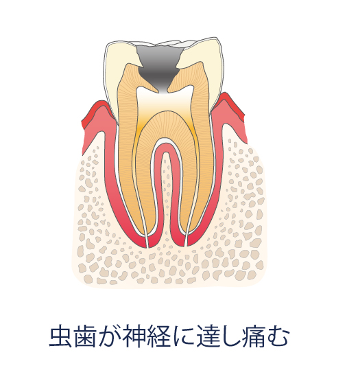 虫歯が神経に達し痛む