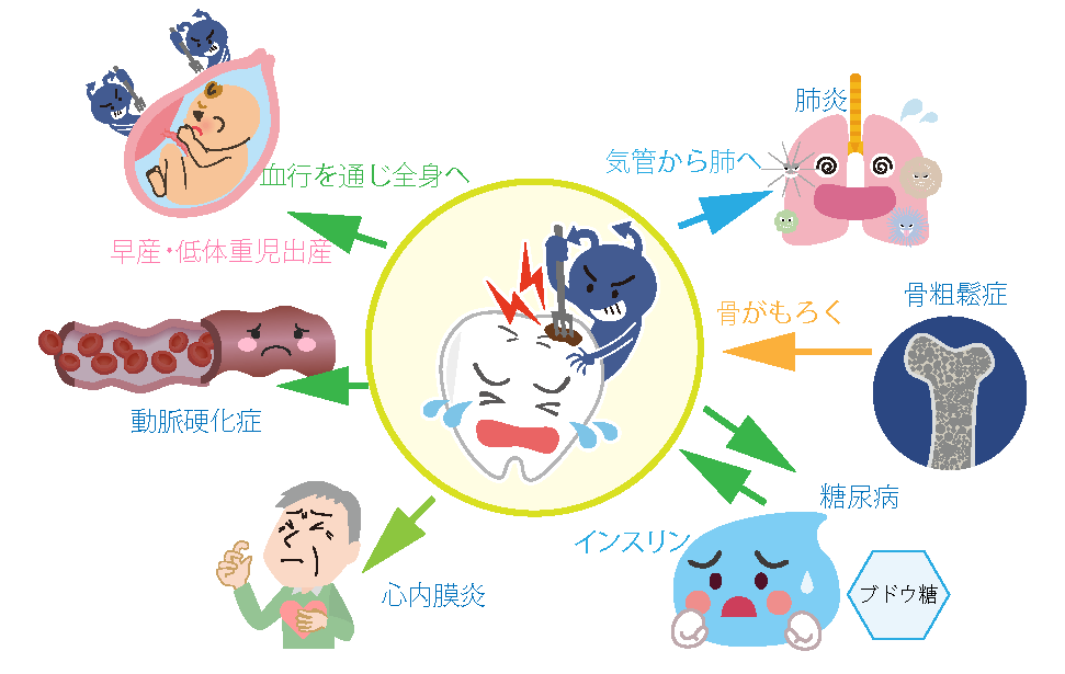 歯周病は全身に悪影響を及ぼす